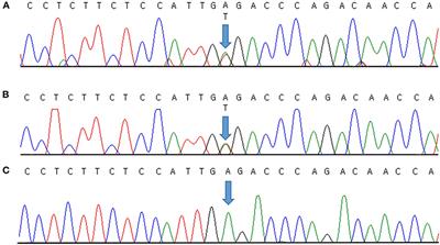 Andersen–Tawil Syndrome With Novel Mutation in KCNJ2: Case Report